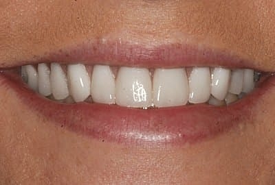 Smiling person with healthy, white teeth.