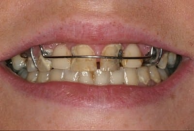 Close-up of teeth with dental device.