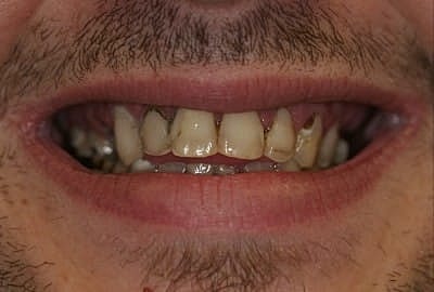 Close-up of a person's damaged teeth.