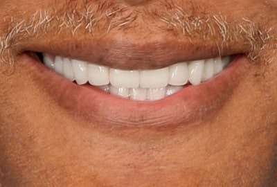 Close-up of smiling mouth with white teeth.