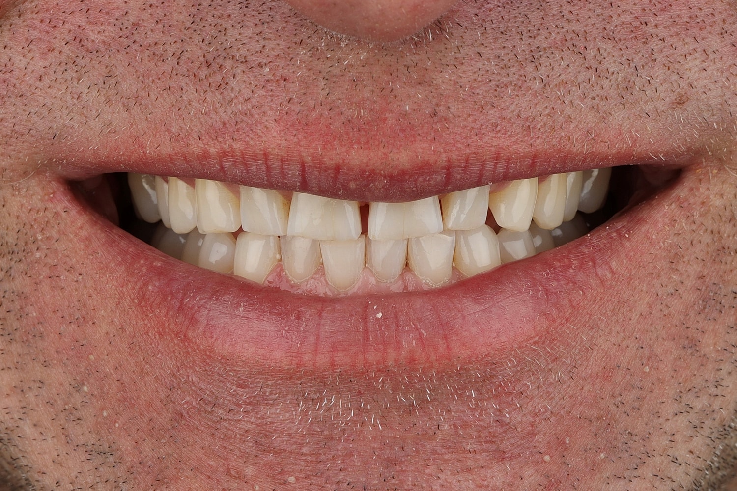 Close-up of a smiling mouth with teeth.
