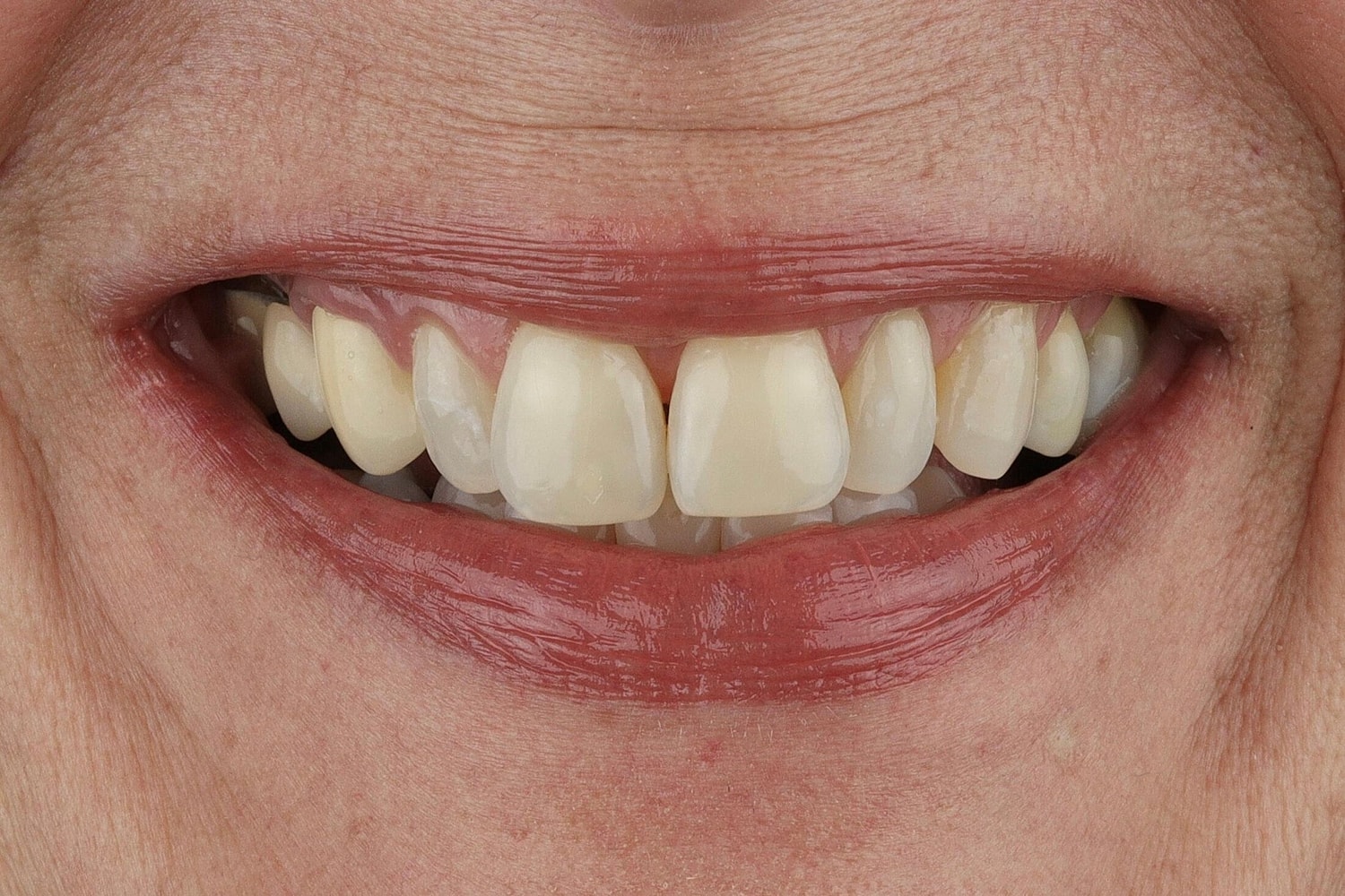 Patients Before & After