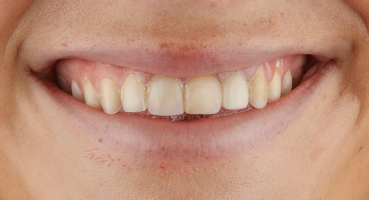 Patients Before & After