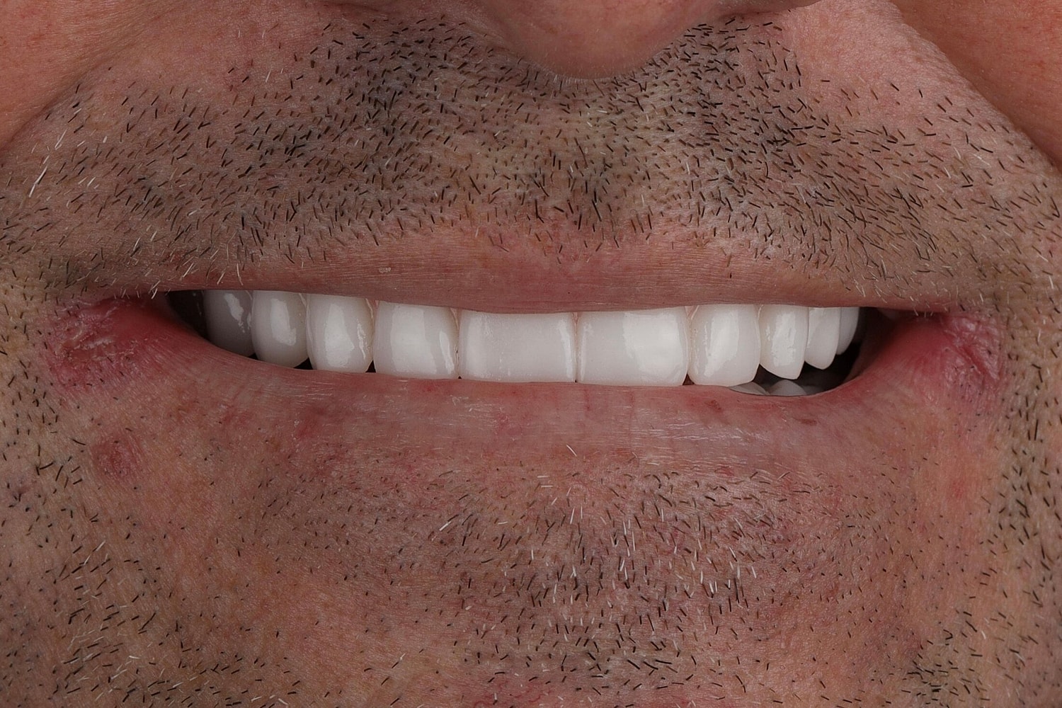Smiling mouth with bright, white teeth.