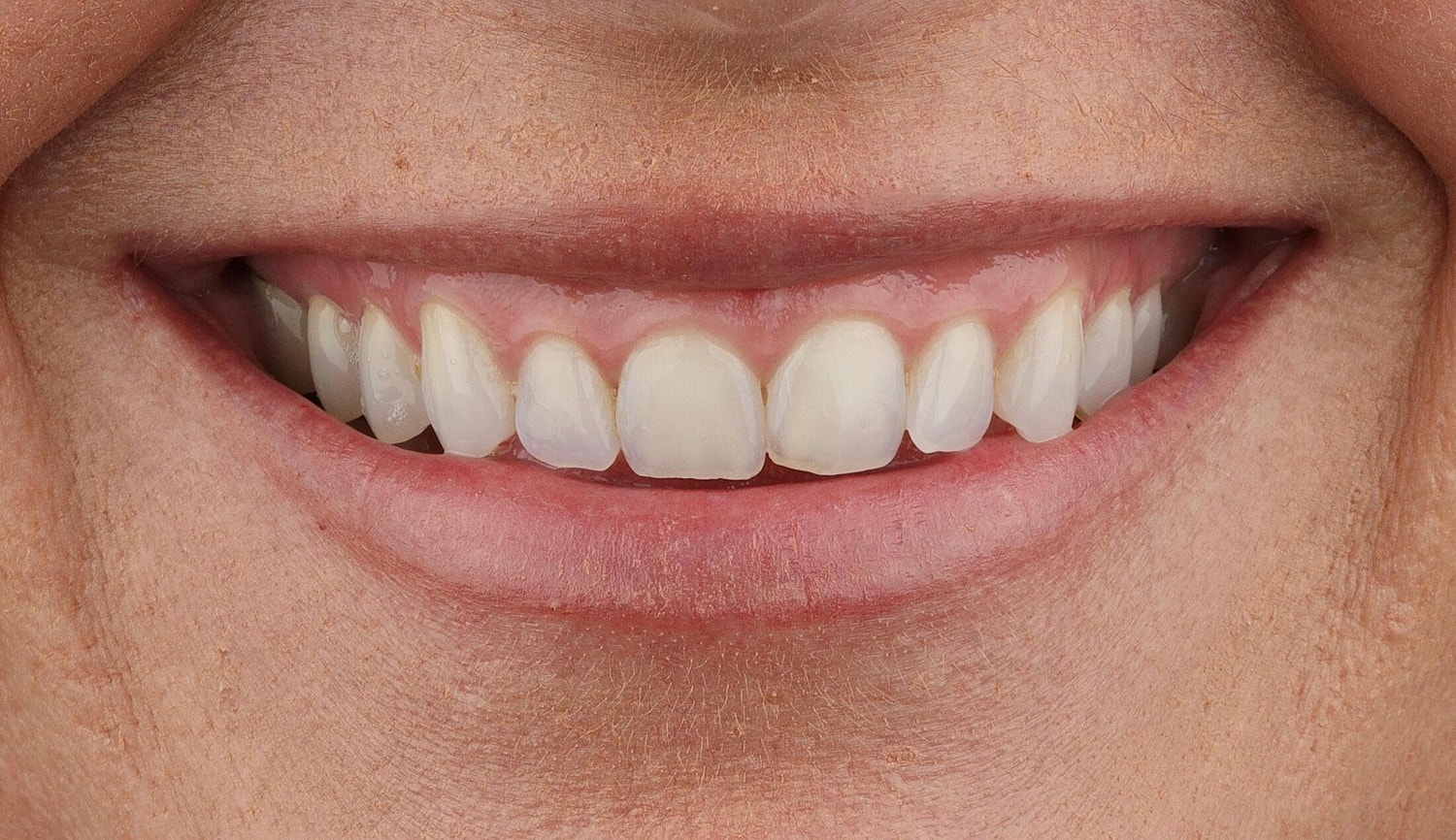 Patients Before & After