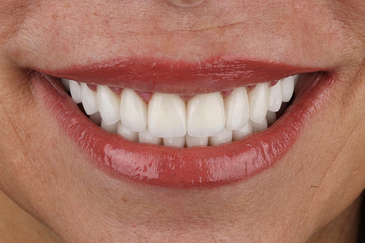 Close-up of a smiling mouth with white teeth.