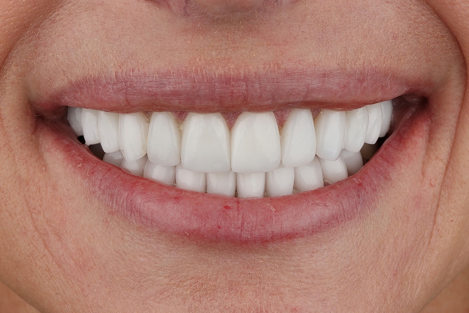 Close-up of bright, healthy smile showing teeth.