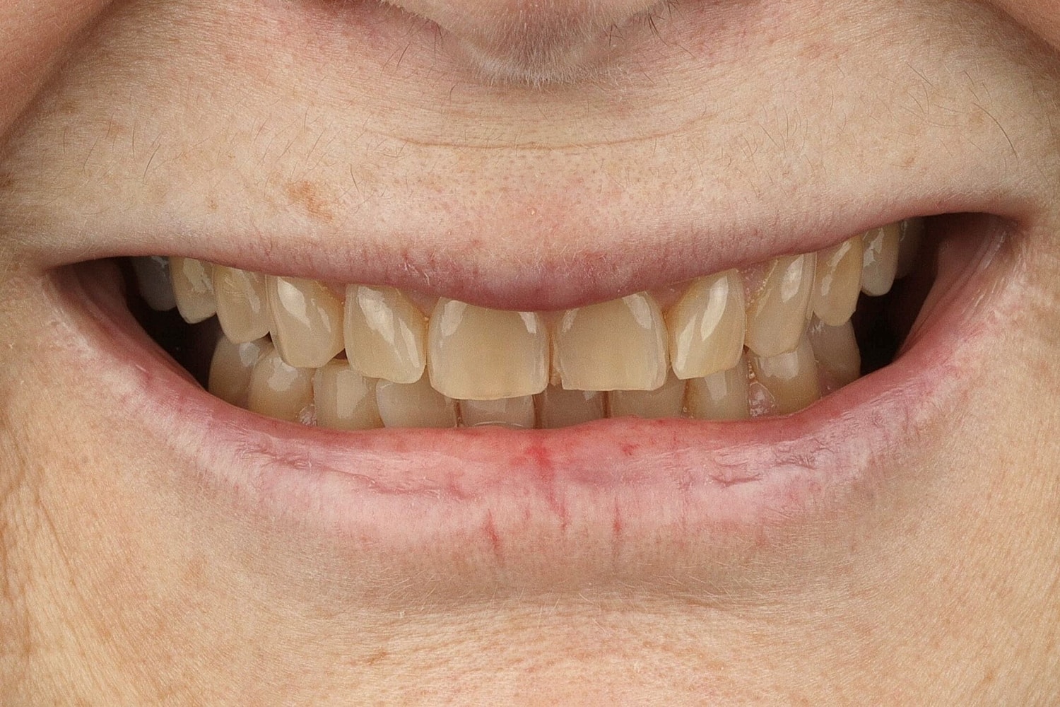 Patients Before & After
