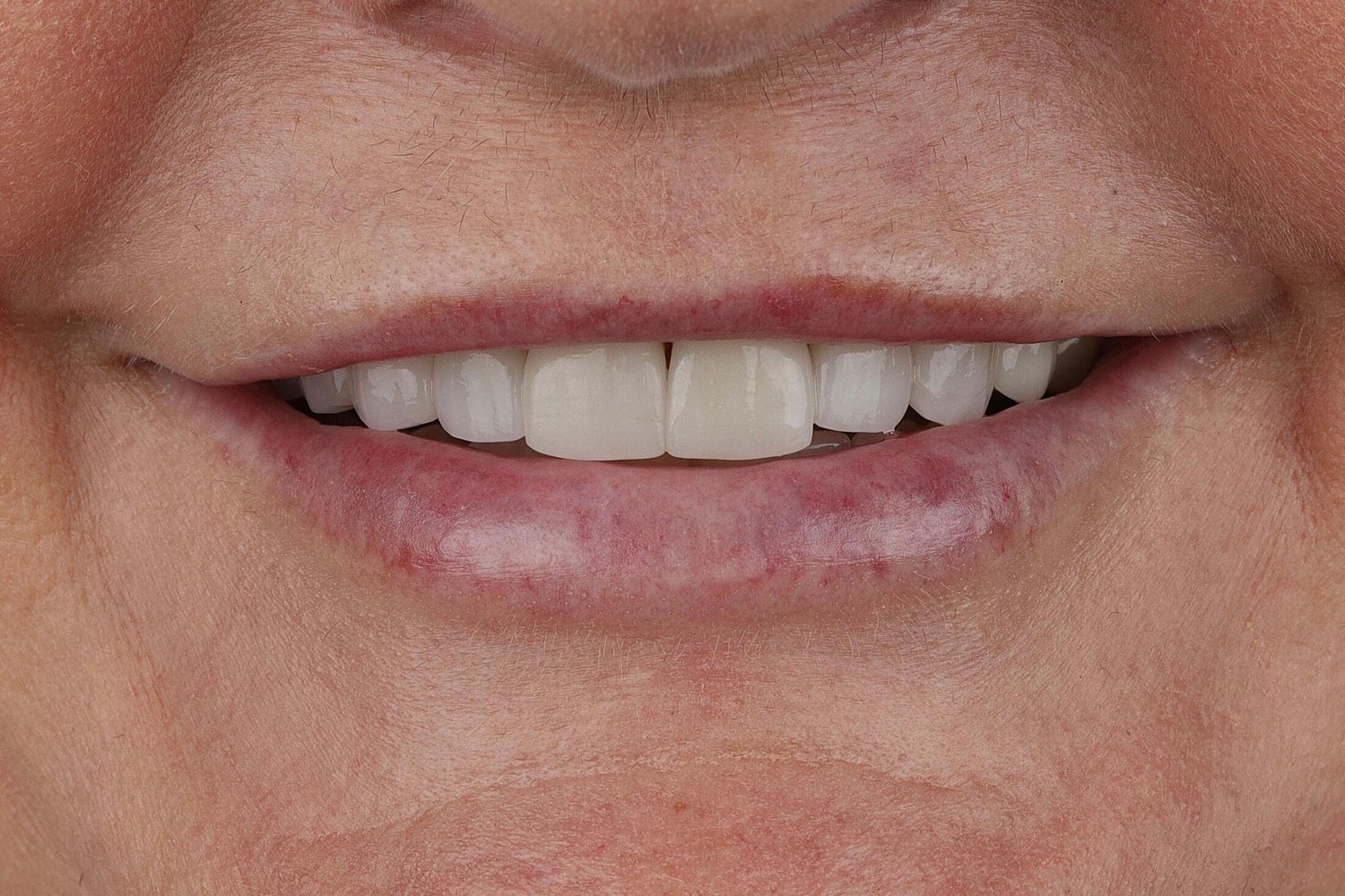 Patients Before & After