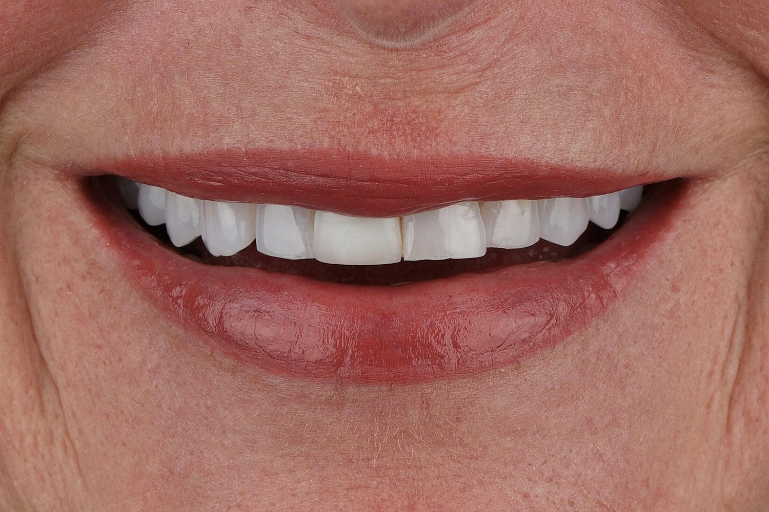 Patients Before & After