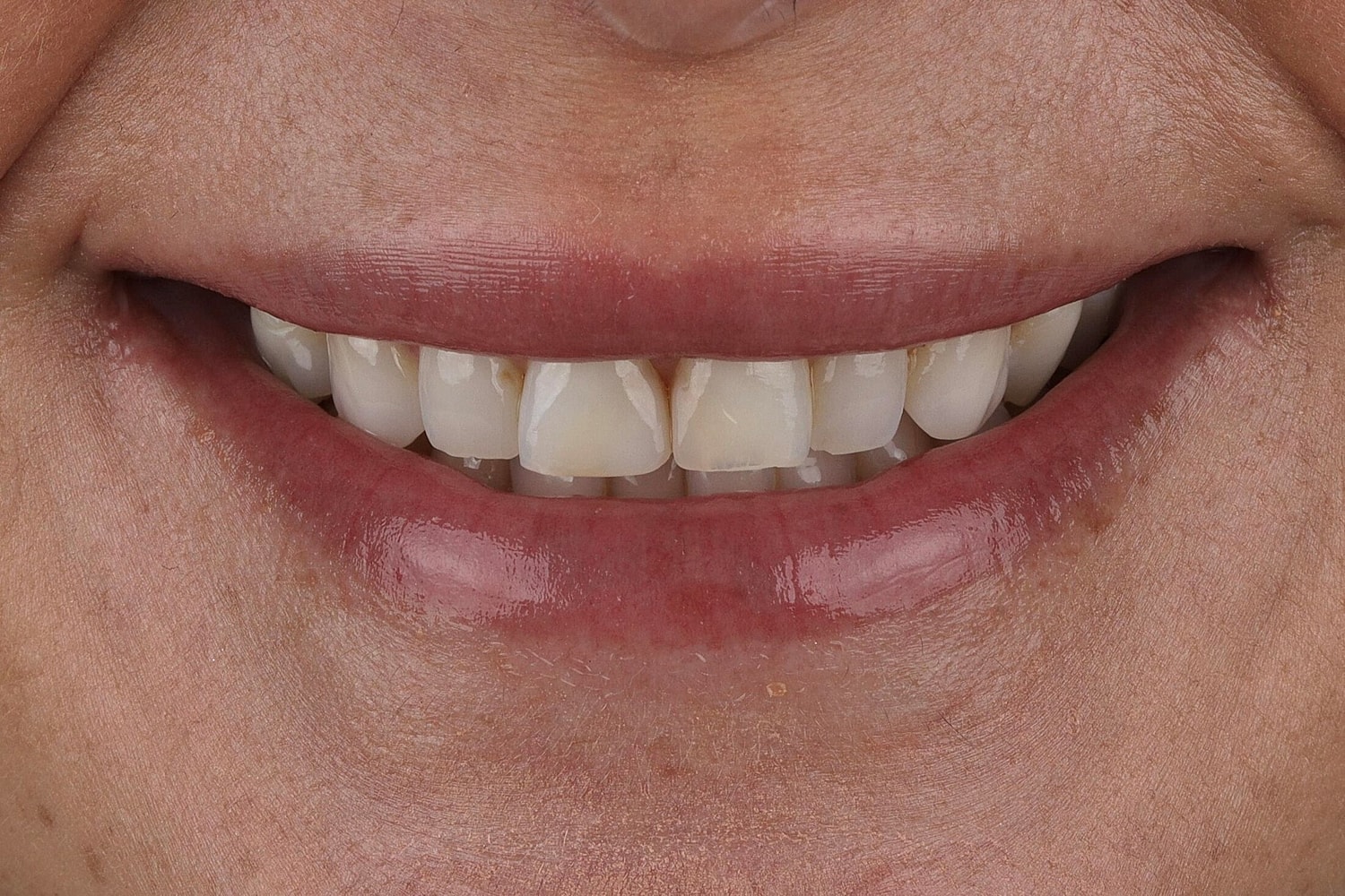 Patients Before & After