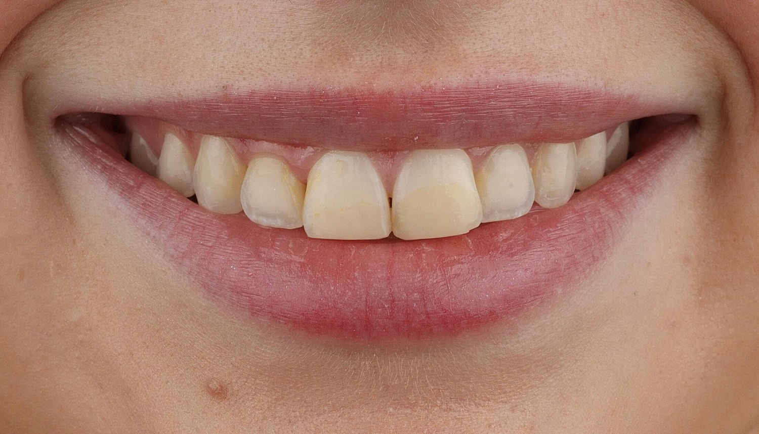 Patients Before & After