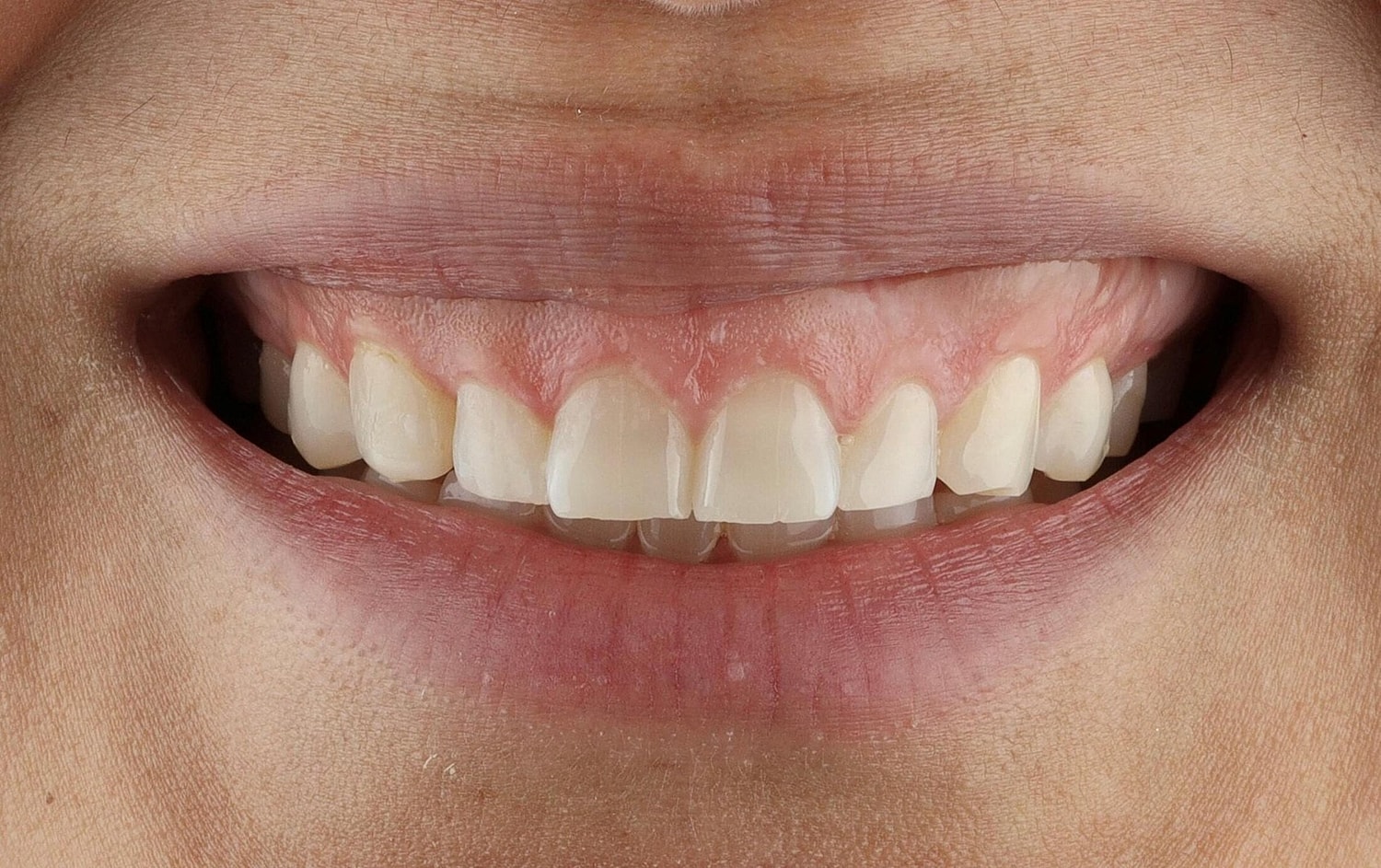 Patients Before & After