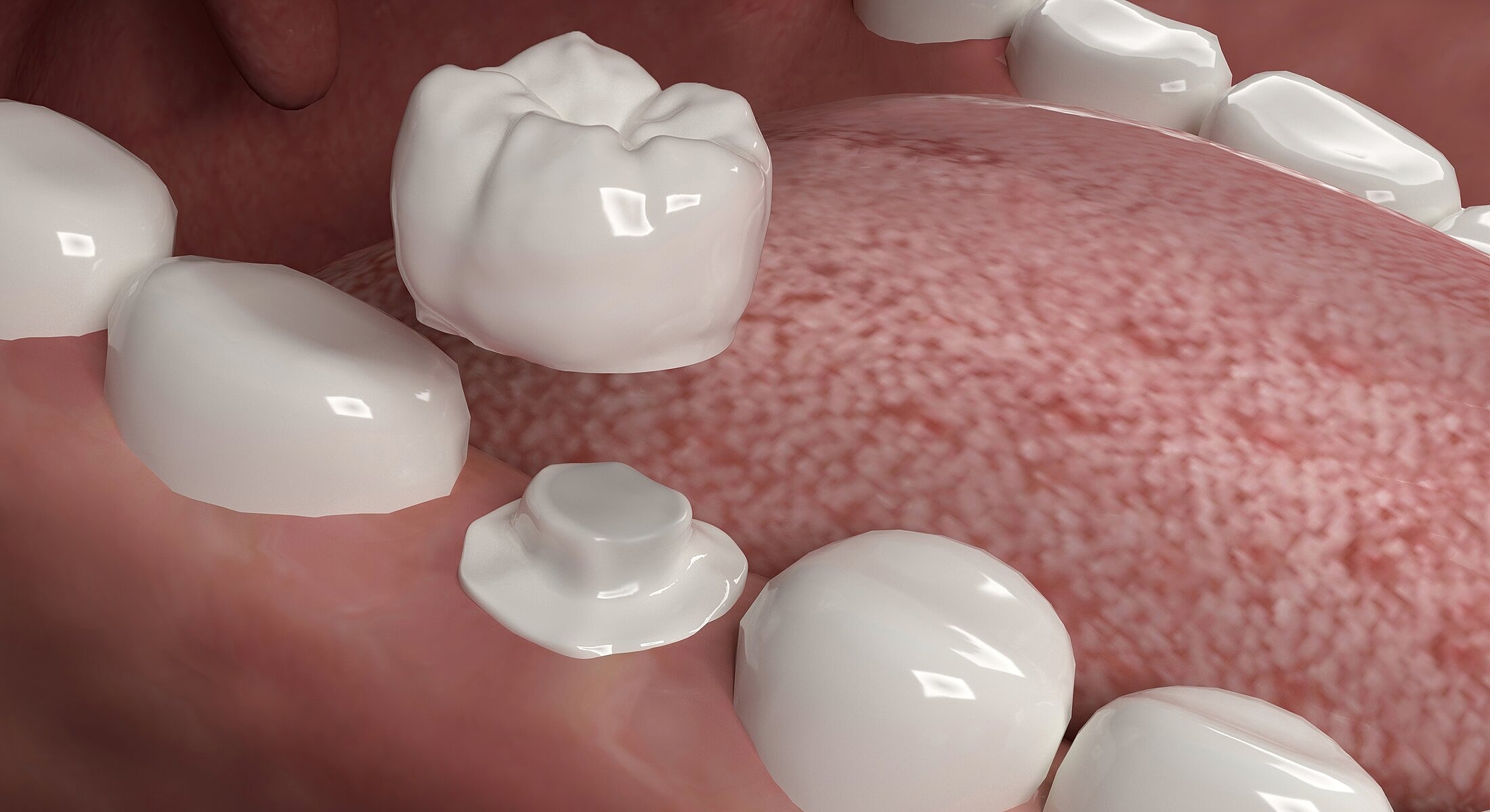 Dental crowns in a close-up view of mouth.